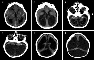 Neurodevelopment in Children Exposed to Zika in utero: Clinical and Molecular Aspects
